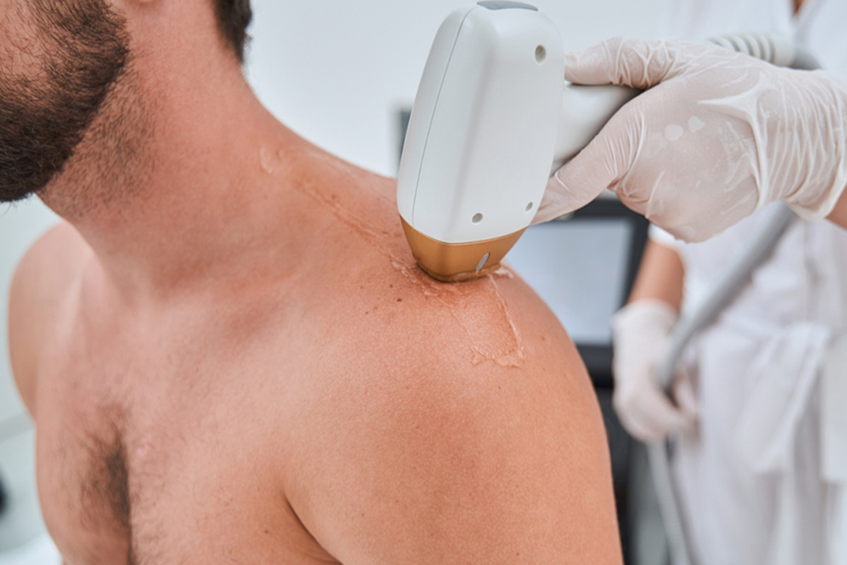 6 laser-ontharingsbehandelingen (zone naar keuze)