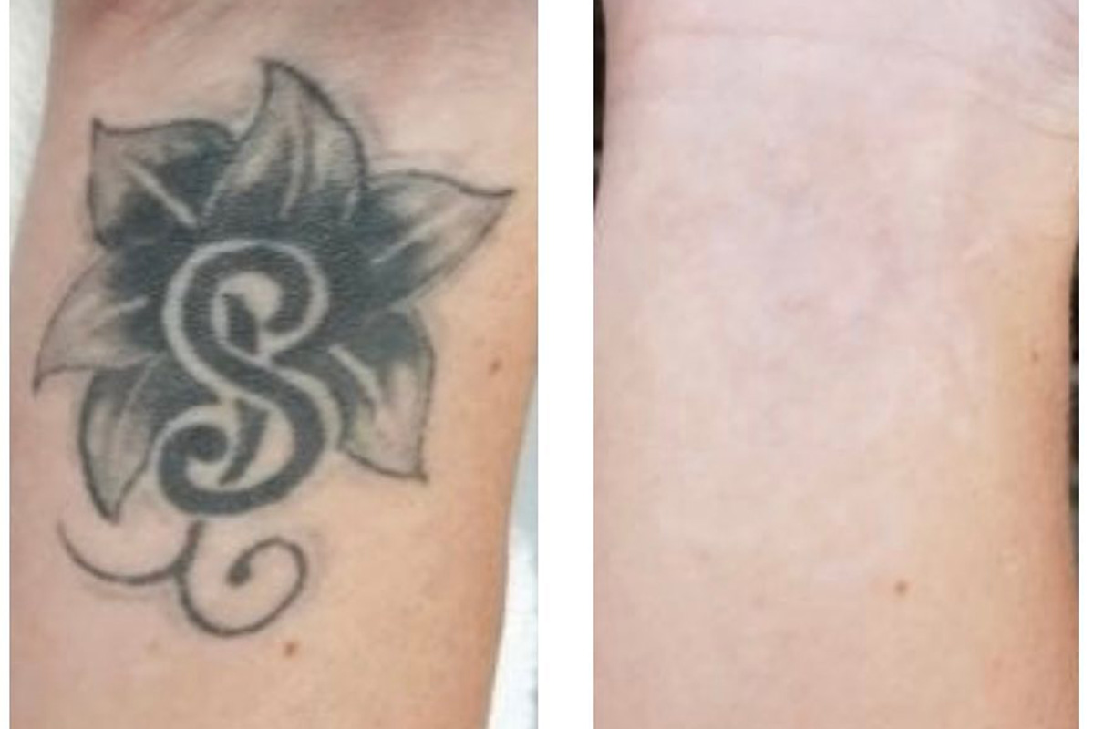Tatoeage verwijderen bij Heesakkers Beauty 